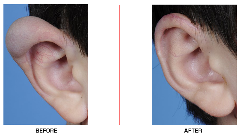 Microtia Ear Reconstruction before after case11