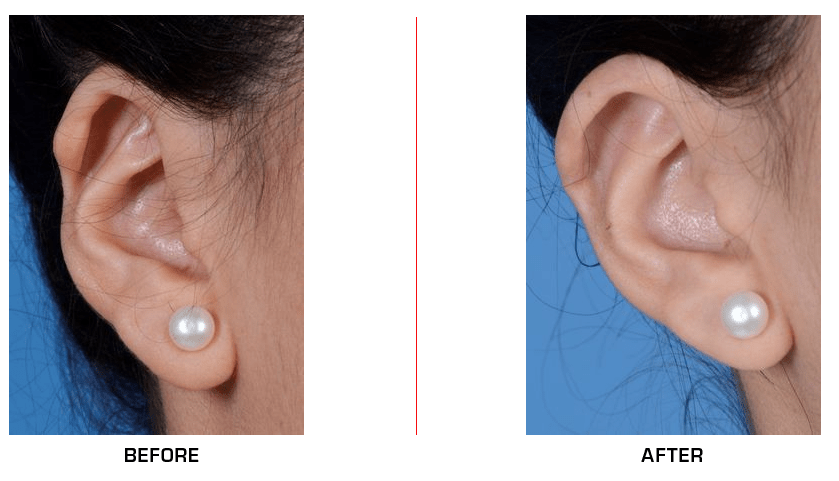 Ear Reconstruction before after case2