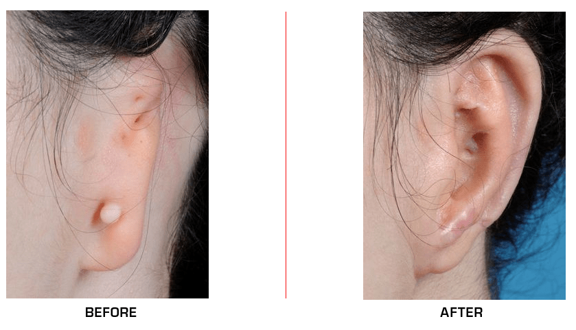 Ear Reconstruction before after case4