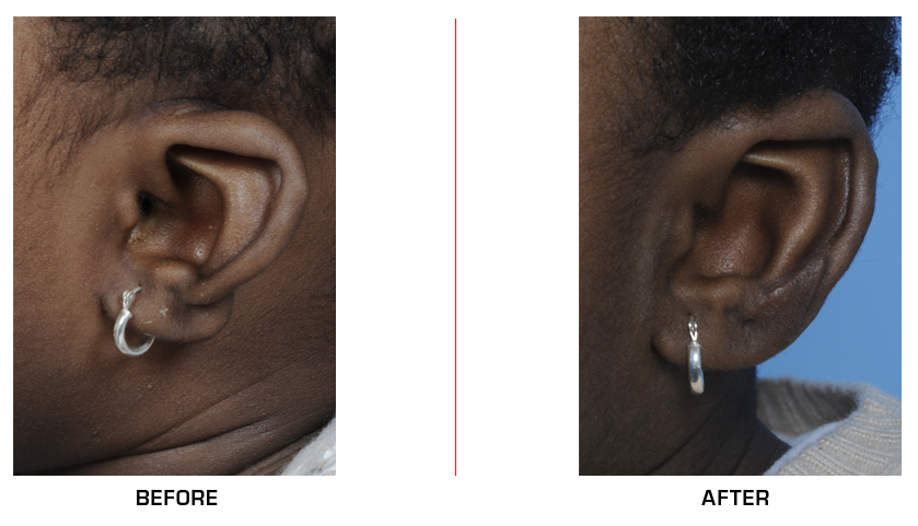 Microtia Ear Reconstruction before after case12