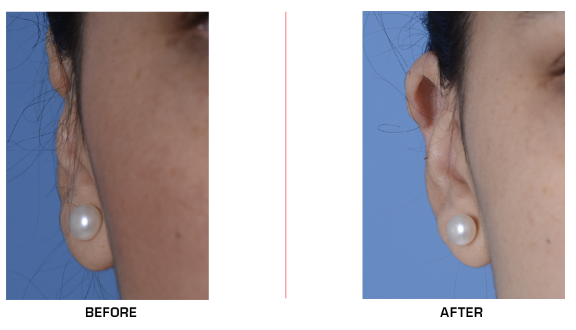 Microtia Ear Revision before after case1