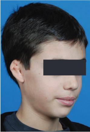 patient with microtia 1