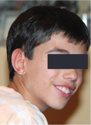patient with microtia 2