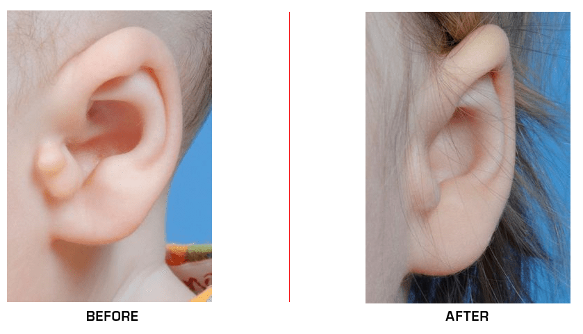 Ear Reconstruction before after case3