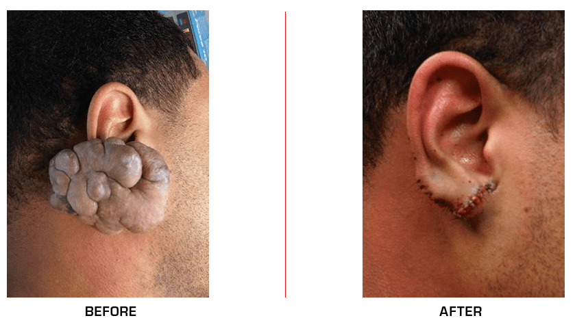 Ear Reconstruction before after case5