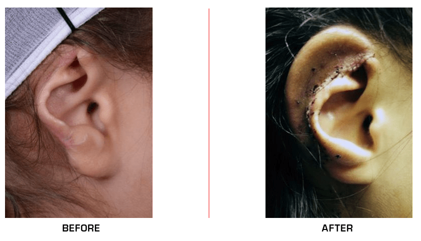 Ear Reconstruction before after case8